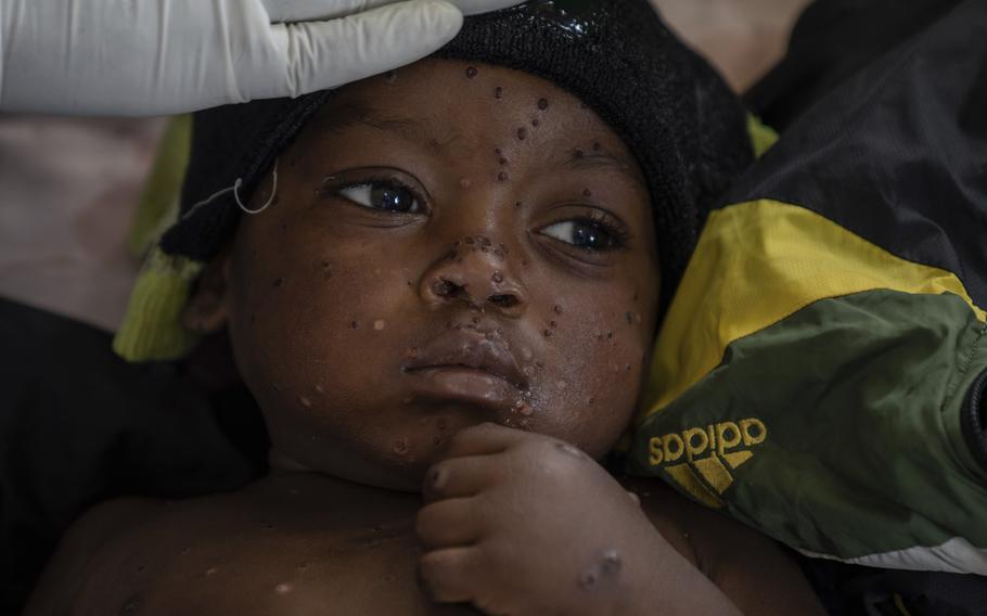 2 year old Emile Miango, who has mpox, lies in a hospital