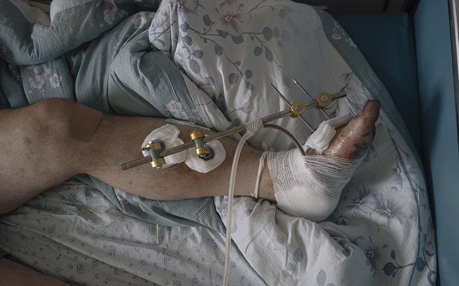 Ukrainian serviceman Oleh while undergoing vacuum therapy.