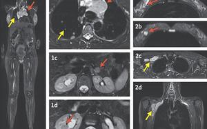 These MRI images with arrows indicating cancer were made during a study by researchers at the National Institutes of Health and published Wednesday, Dec. 4, 2024, in the New England Journal of Medicine. (The New England Journal of Medicine via AP)