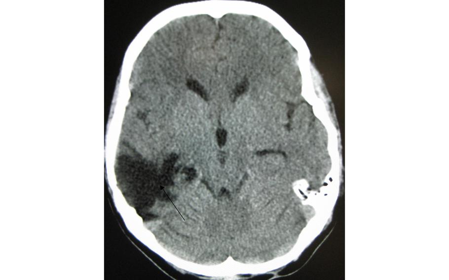 A computed tomography (CT) scan of a head years after a traumatic brain injury showing an empty space marked by the arrow where the damage occurred.