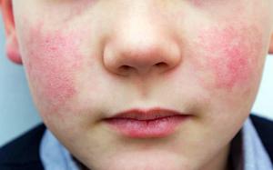 The lower half of a child’s face with rough, reddened cheeks.