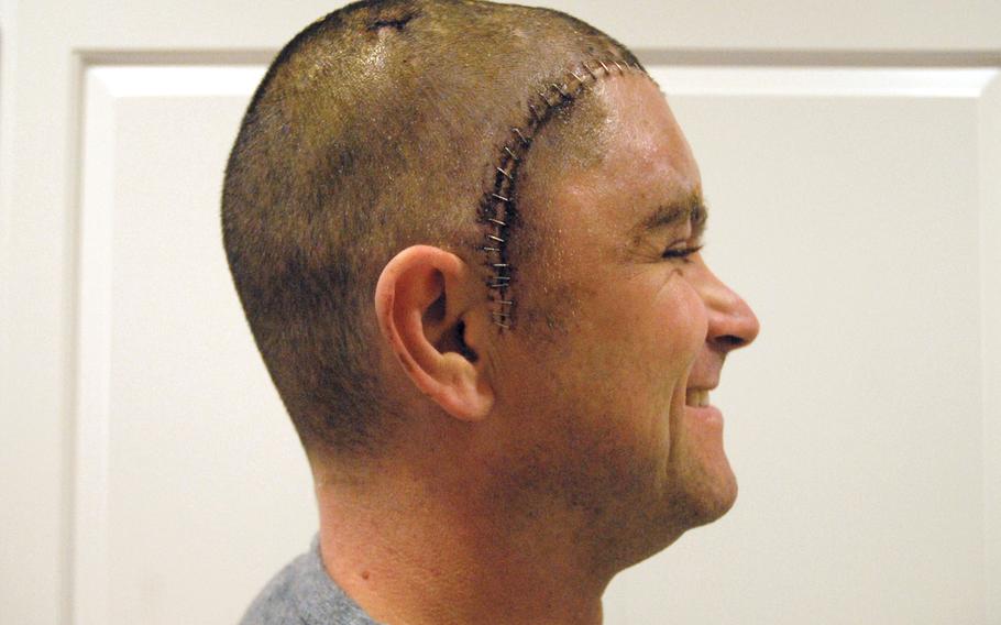 Staff Sgt. Dominic Annecchini shortly after having major reconstructive surgery at Walter Reed to fix his skull with a titanium prosthetic.