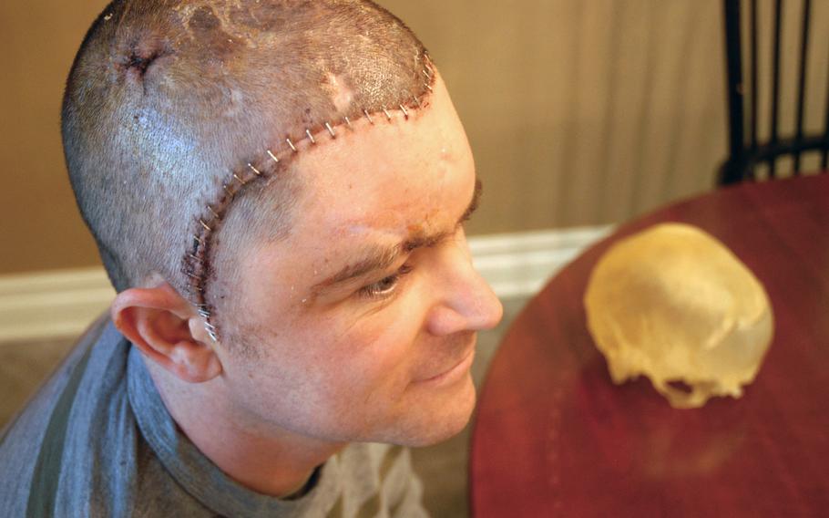 In January 2013, Staff Sgt. Dominic Annecchini sits next to a  plastic mold of his skull that shows the piece that was taken out after he was shot in Afghanistan. Annecchini had a cranioplasty to replace his bone with a prosthetic piece the week before.