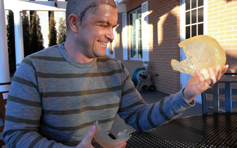 In January 2013, Staff Sgt. Dominic Annecchini holds up a  plastic mold of his skull that shows the piece that was taken out after he was shot in Afghanistan. Annecchini had a cranioplasty to replace his bone with a prosthetic piece the week before.