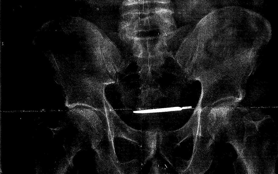 This X-ray image provided by the attorney for Glenford Turner, of Bridgeport, Ct., shows a scalpel that Turner claims was left inside him after undergoing surgery in 2013 at a Veterans Administration hospital in Connecticut. The army veteran is suing the hospital after the scalpel was only discovered years later and he suffered from long-term abdominal pain.