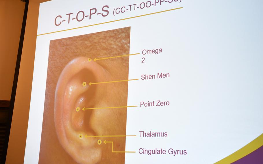 A slide shows the five points on the ear where needles are placed for battlefield acupuncture. The theory of ear acupuncture holds that each region of the ear corresponds to a body function or area of illness or pain.