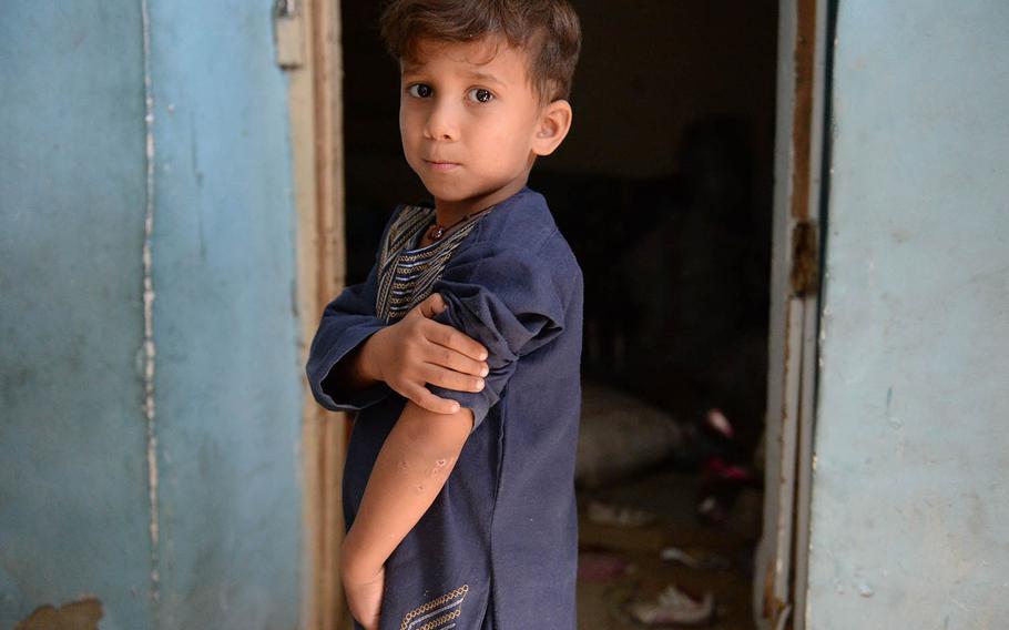 A young Afghan boy on Oct. 8, 2017, reveals the wounds he got when a U.S. missile hit is house in Kabul more than a week before, injuring several of his family members.
