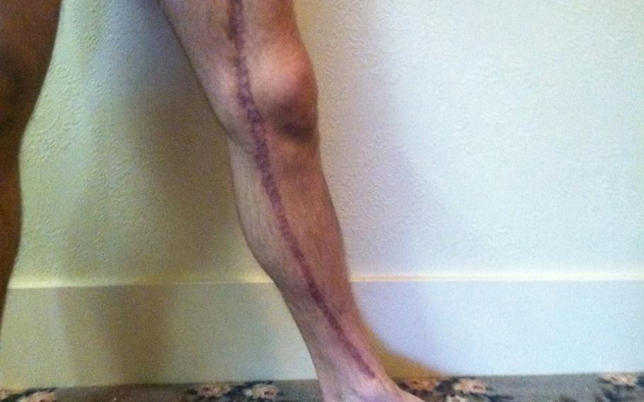 Former Green Beret Kevin Flike shows the scar where doctors took a nerve in his leg to graft into his stomach, in a photo taken in Tacoma, Wash., in 2012. Flike?s left leg was paralyzed and had atrophied to the size of his arm, but an experimental treatment helped restore his ability to move that leg, signaled at first by a lone muscle twitch.